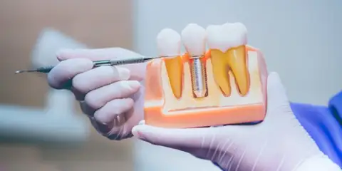 How Long Do Dental Implants Last? Understanding Durability